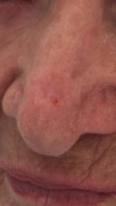Базалиома кожи носа: второй рецидив после второго хирургического лечения