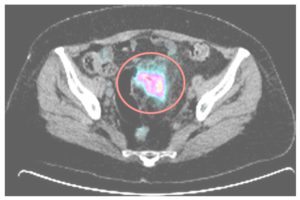 Пример снимка, сделанного при помощи ПЭТ КТ -сканера. Красным цветом выделена зона локализации опухоли