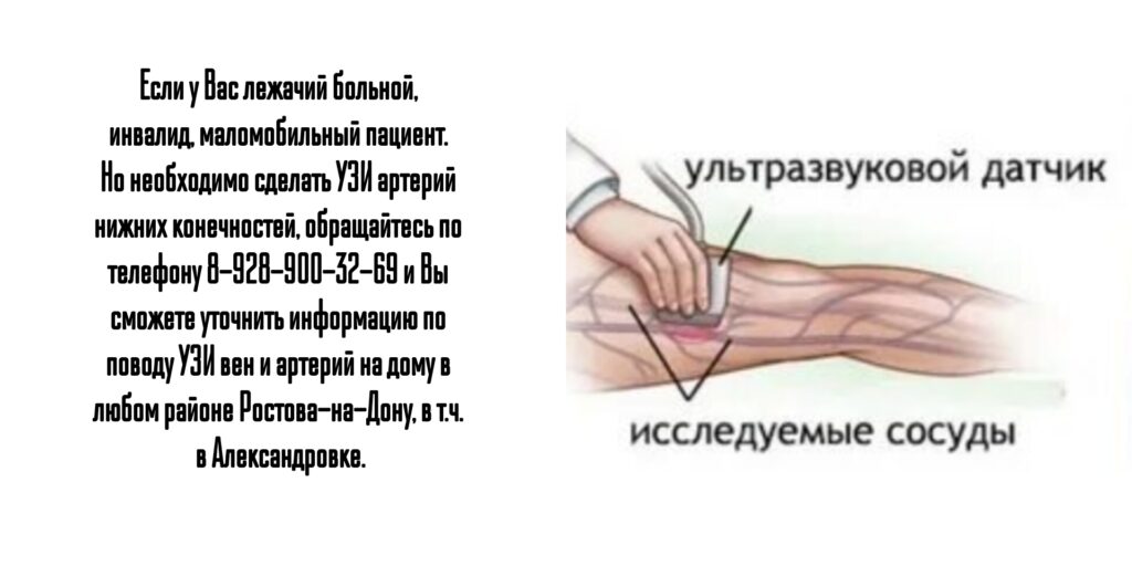 УЗИ артерий нижних конечностей - Александровка