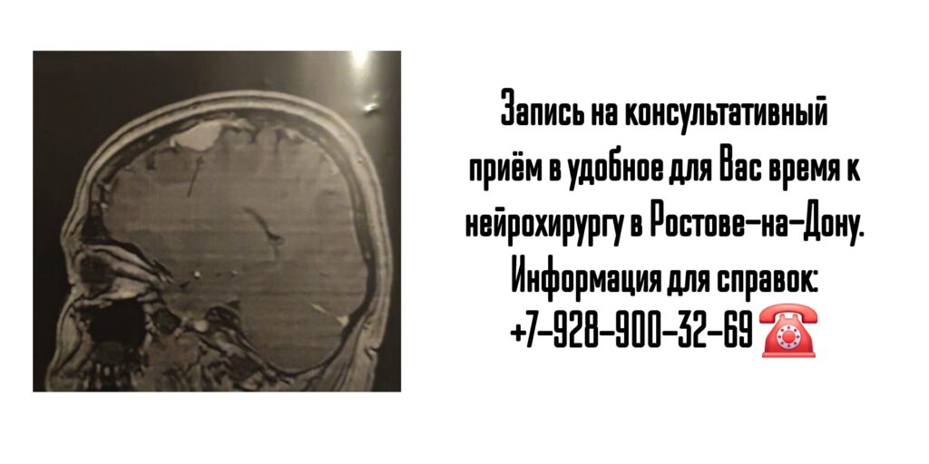Консультация нейрохирурга в Ростове-на-Дону- Молдованов Владимир Архипович