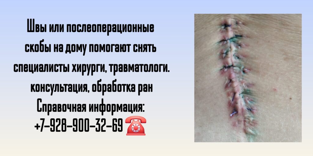 Ростов-на-Дону - микрорайон Александровка - снятие швов после операции