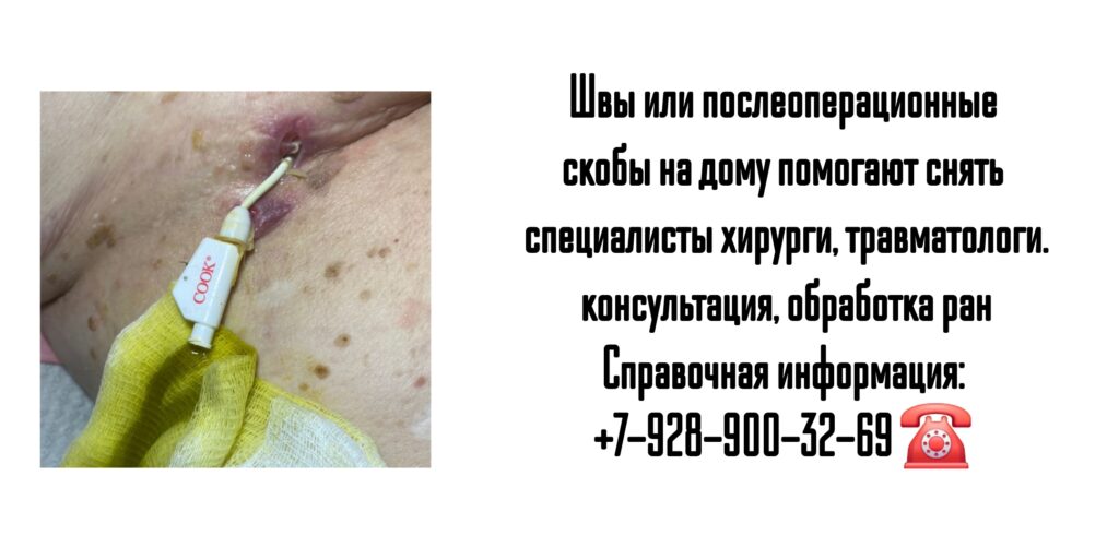 Ростов-на-Дону - микрорайон Александровка - снятие швов после операции