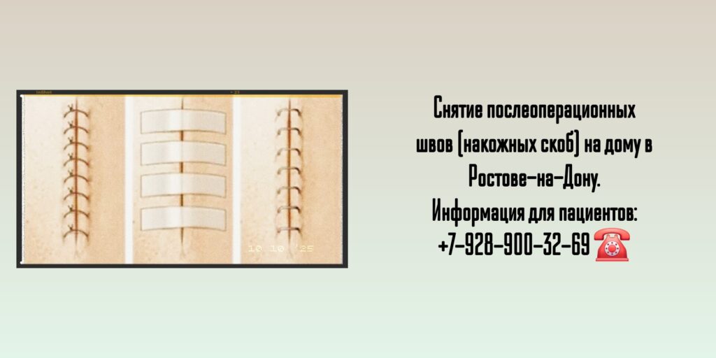 Снятие послеоперационных швов в травматологии - выезд хирурга на дом
