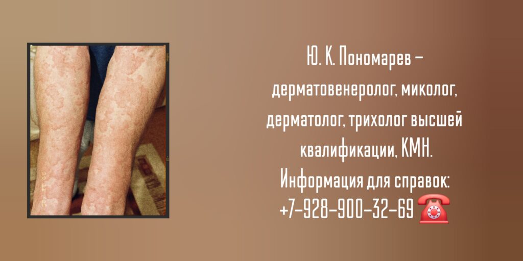 Пономарев Юрий Константинович - дерматолог - дерматовенеролог Ростов