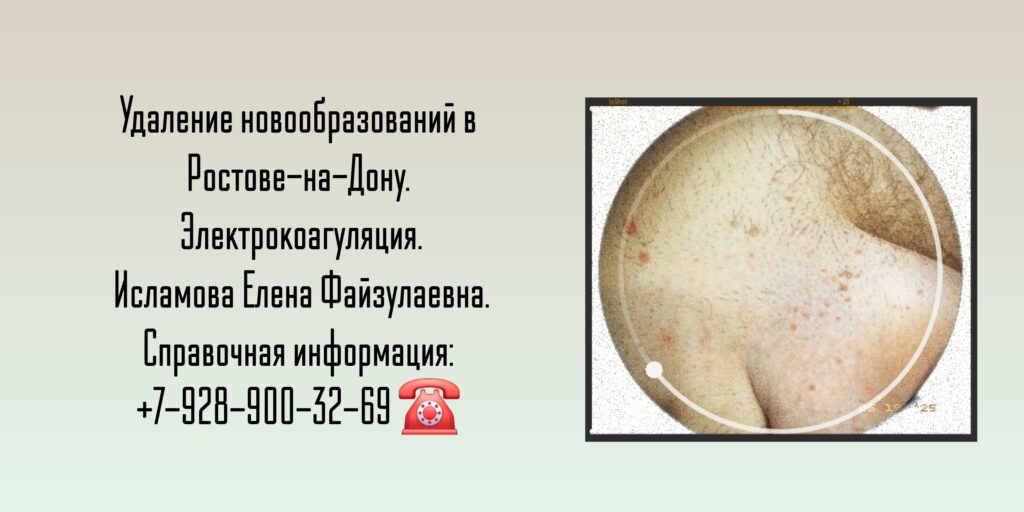 Электрокоагуляция кондилом Ростов-на-Дону - Исламова Елена Файзулаевна