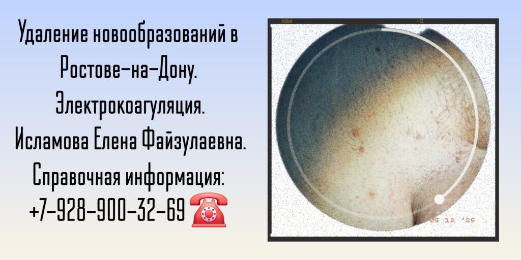 Электрокоагуляция кондилом Ростов-на-Дону - Исламова Елена Файзулаевна