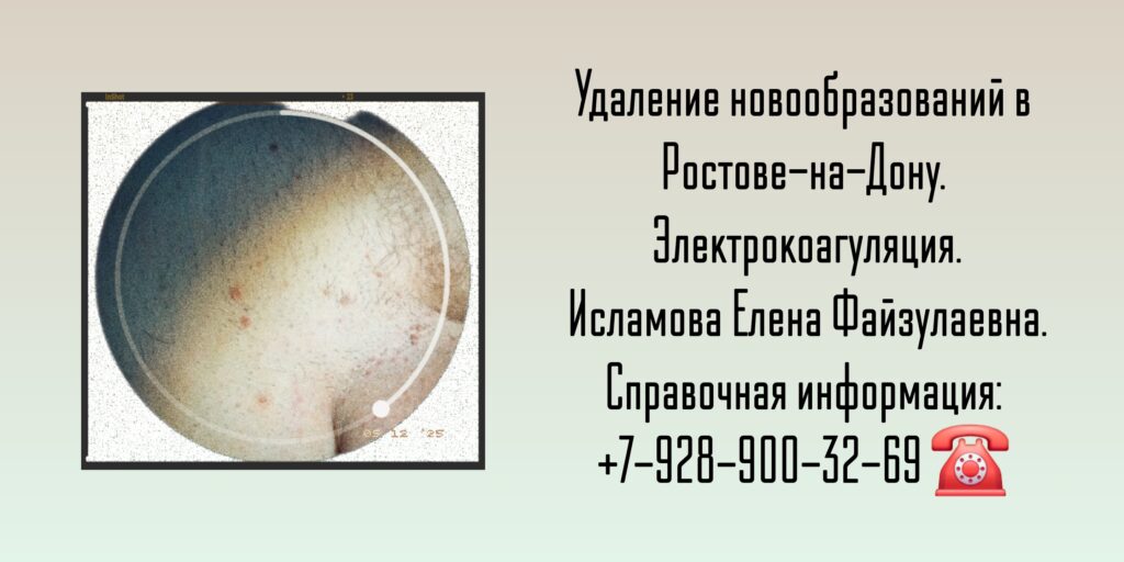 Электрокоагуляция кондилом Ростов-на-Дону - Исламова Елена Файзулаевна