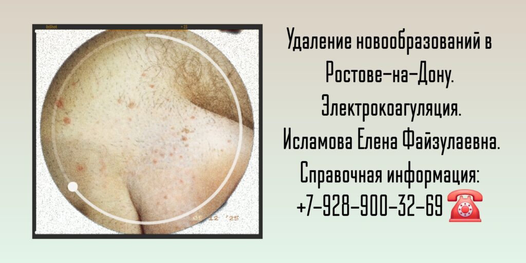 Электрокоагуляция кондилом Ростов-на-Дону - Исламова Елена Файзулаевна