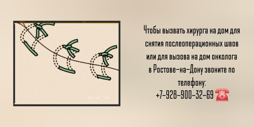 Вызов хирурга на дом для снятия послеоперационных швов 