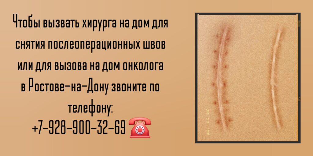 Вызов хирурга на дом для снятия послеоперационных швов 
