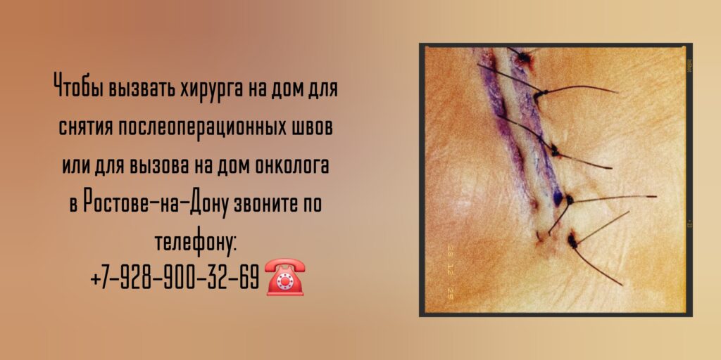 Вызов хирурга на дом для снятия послеоперационных швов 