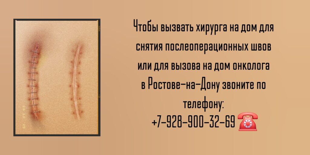 Вызов хирурга на дом для снятия послеоперационных швов 