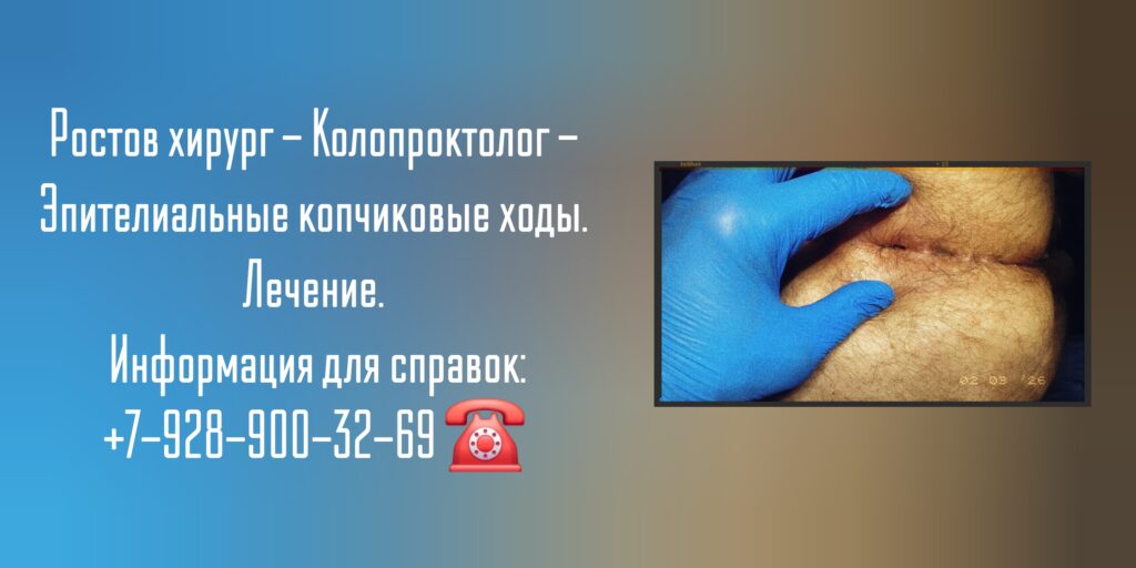 Ростов хирург - Колопроктолог - Эпителиальные копчиковые ходы
