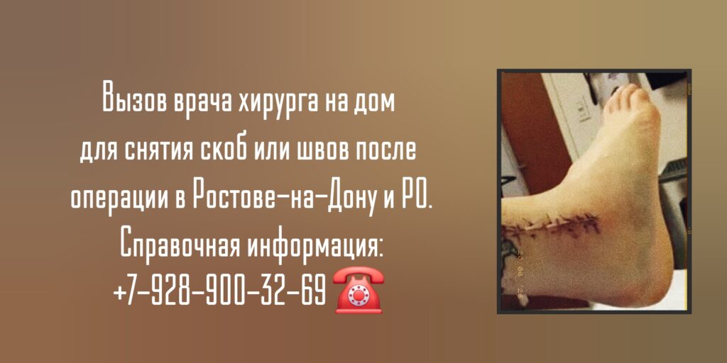Снять скобы или швы на дому после операции - Ростов-на-Дону 