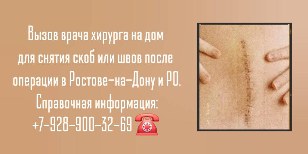 Снять скобы или швы на дому после операции - Ростов-на-Дону 