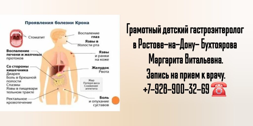 Консультация детского гастроэнтеролога в Ростове-на-Дону- болезнь Крона