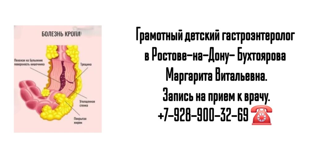 Консультация детского гастроэнтеролога в Ростове-на-Дону- болезнь Крона