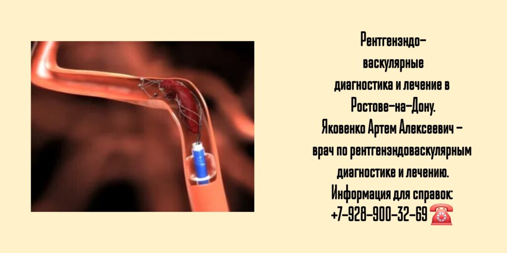 Яковенко Артем Алексеевич - врач по рентгенэндоваскулярным диагностике и лечению в Ростове-на-Дону